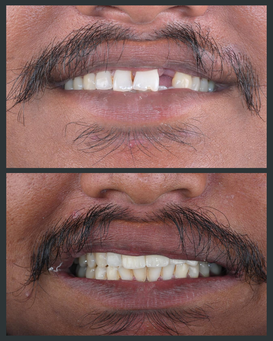 Dental implant treatment result at Floss-it Dental Clinic