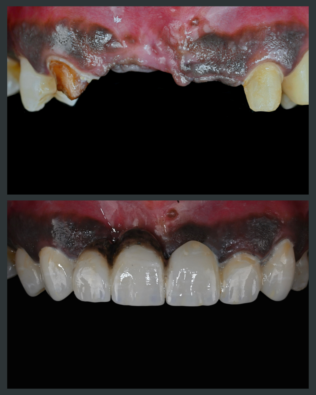 Dental implant treatment result at Floss-it Dental Clinic