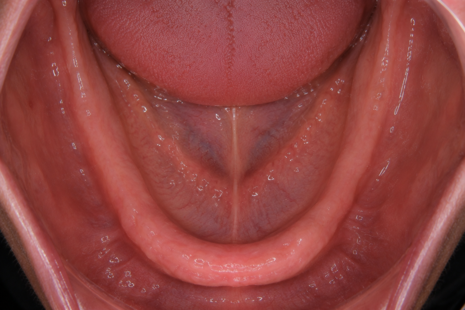 Illustration of full arch tooth loss