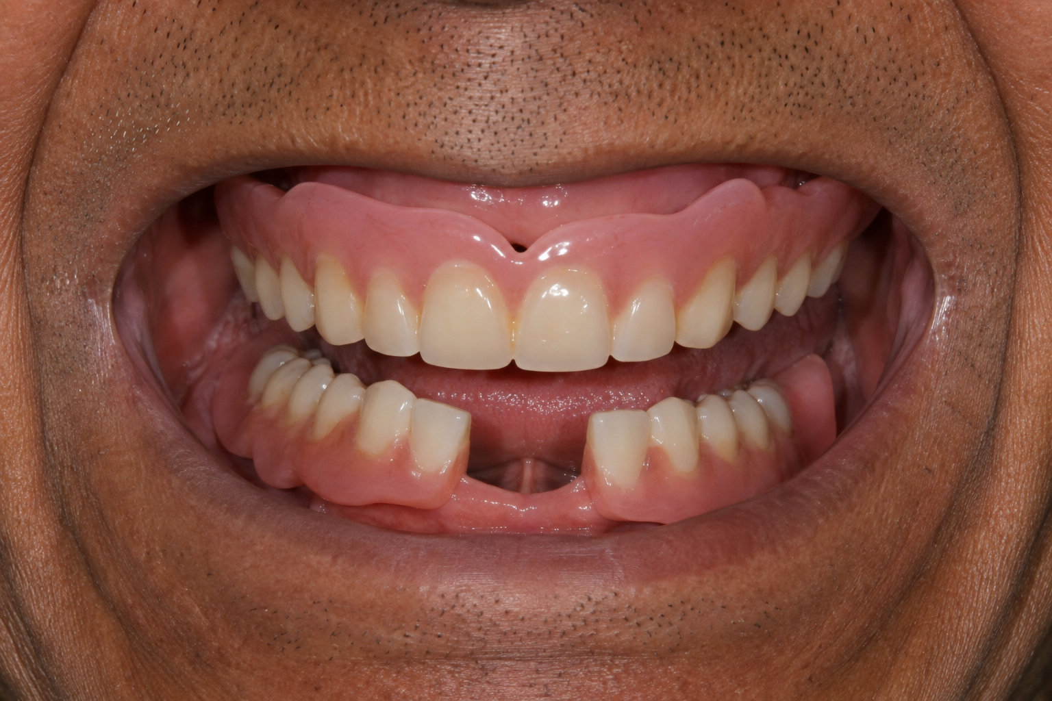 Illustration of ill-fitting or loose denture