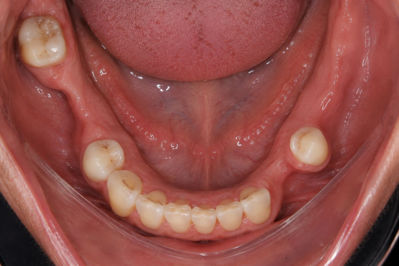 Illustration of multiple missing teeth